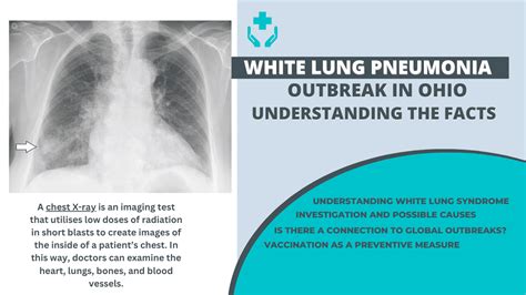 What is 'White Lung Syndrome,' the Ohio child pneumonia outbreak?