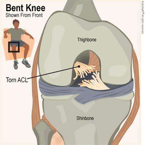 What is ACL Tear & how to reduce the pain? NuvoVivo Reverse Your Age