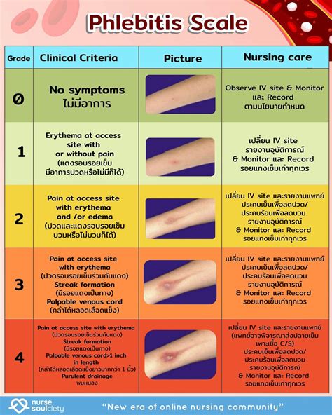 What is Grade 3 Phlebitis? - Alltheasks.com