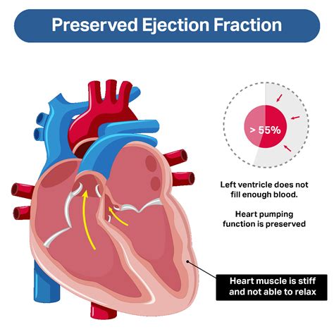 What is Heart Failure with Preserved Ejection Fraction?