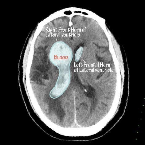 What is Intraventricular Hemorrhage? IVH