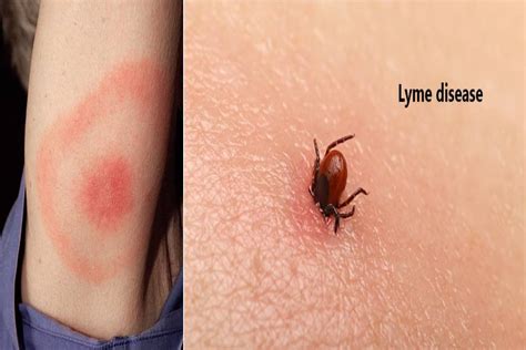 What is Lyme disease?