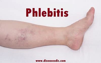 What is Phlebitis? Types, Signs, Causes, & Treatment