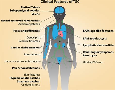 What is TSC? - TSCI - Tuberous Sclerosi…