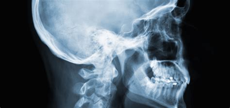 What is a CEPH X-ray, and Do I Need One?