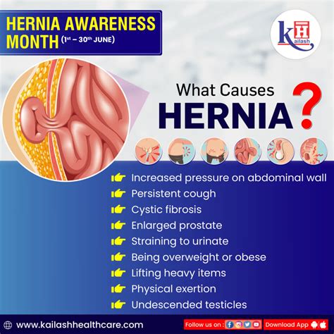 What is a Hernia Truss? (with pictures) - Info Bloom