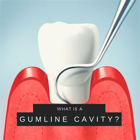 What is a gumline cavity and can it be filled?