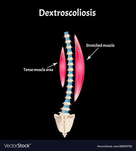 What is a mild dextrocurvature in the lumbar spine? - Answers