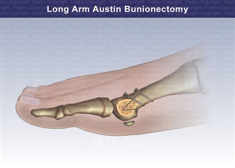 What is an Austin akin Bunionectomy? – KnowledgeBurrow.com