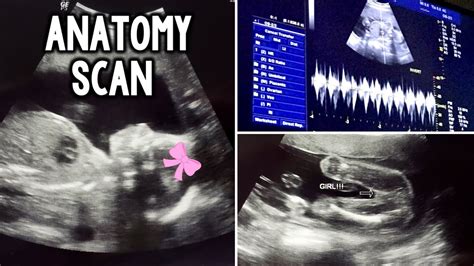What is an anatomy scan when pregnant