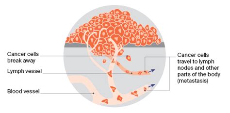 What is cancer called when it spreads