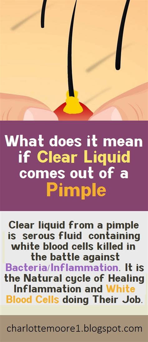 What is clear liquid coming out of pimple. Clear liquid: Clear liquid coming from a pimple is serous fluid which serves a lubricant and protection of body tissues. Picking pimples can cause serous infection ... Read More. Created for people with ongoing healthcare needs … 