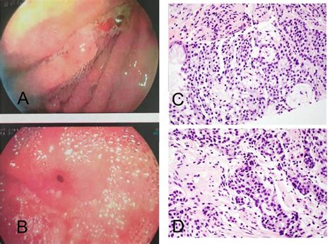 What is erythematous mucosa in the antrum mean? - LAC