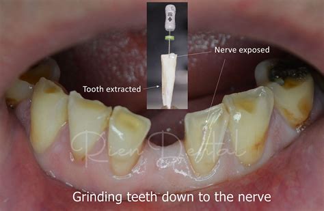 What is grinding teeth called