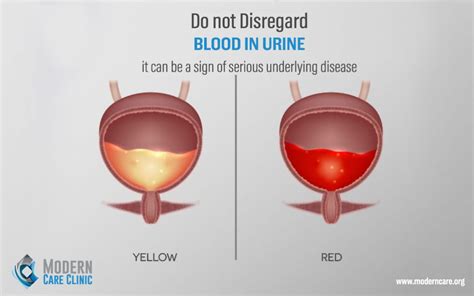 What is it when you urinate blood