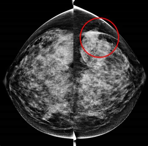 What is nodular asymmetry on mammogram