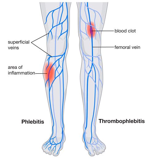Explanation of phlebitis: causes, symptoms and treatments of this disease that affects the veins. Get more information here.
