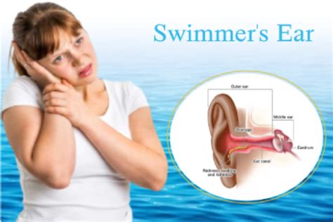 What is swimmer's ear and what causes it?