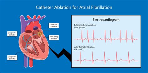 What is the Relationship of Atrial Flutter and Fibrillation?