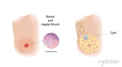 What is thrush in breasts