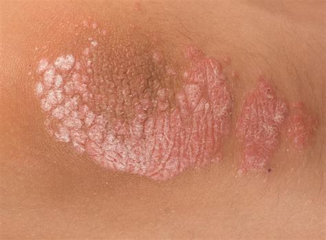 Psoriasis is a chronic skin condition that affects approximately 7.
