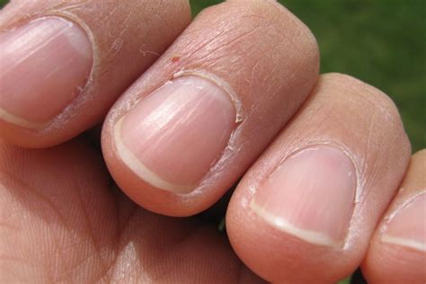 What nails tell you about your health PhillyVoice