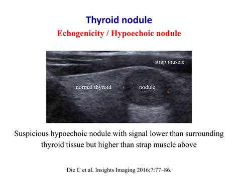 What percentage of hypoechoic thyroid nodules are malignant.  The objective of t...
