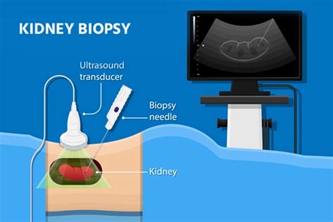 What should I do after kidney biopsy? – idswater.com