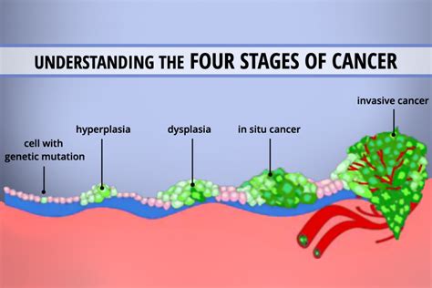 What stage is cancer when it spreads