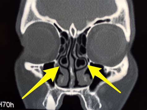 What this mean? ct scan there is a right sided concha