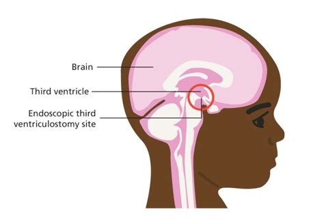 What to Expect With ETV Surgery - Hydrocephalus Association