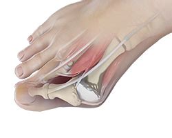 What to Expect from Bunion Removal Surgery in Sugar Land