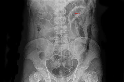 What to Expect from a Ureteral Stent Advanced Urology