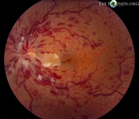 What to Know About a Flame Hemorrhage Contacts Compare