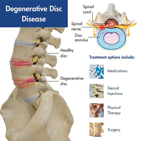 What to avoid with degenerative disk disease