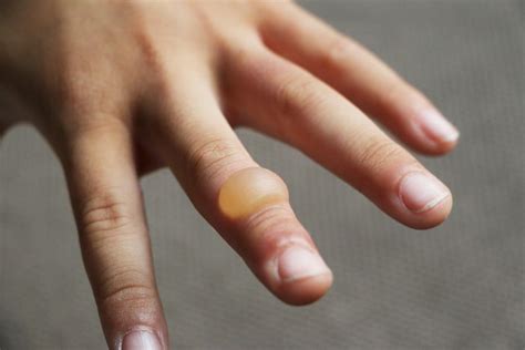 What to do when finger is burned