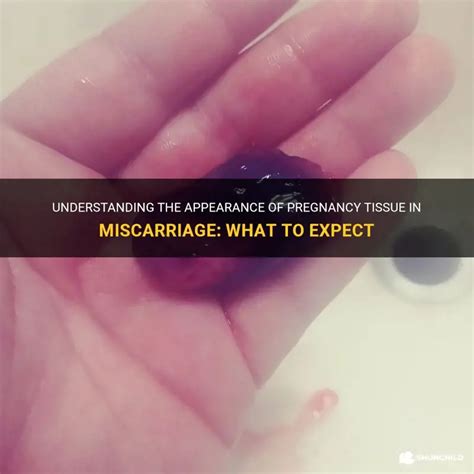 What to expect in miscarriage