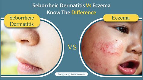 What to know about dermatitis and eczema