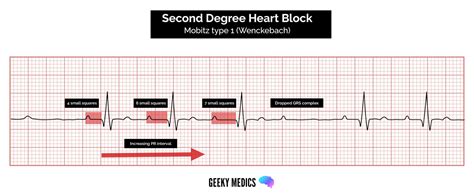 What to know about second degree heart block type 1