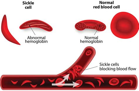 What to know about sickle cell anemia and hemoglobin