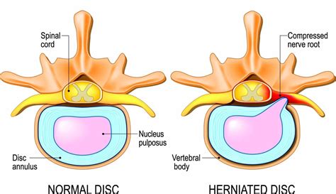 What type of cartilage is the intervertebral disc? - Answers