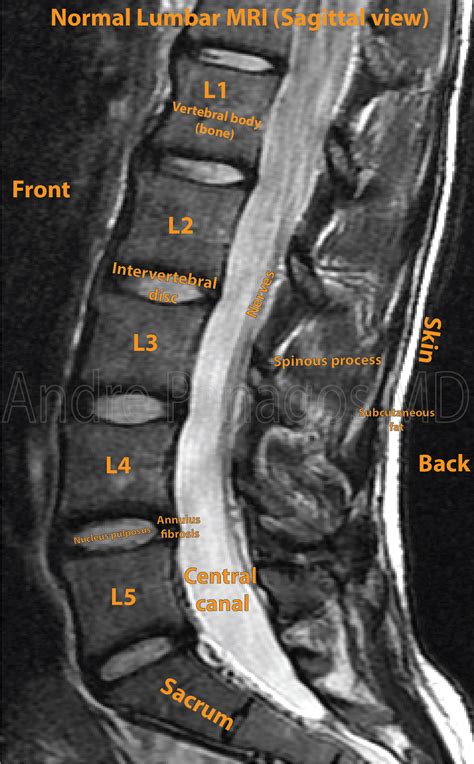 What will mri of back show