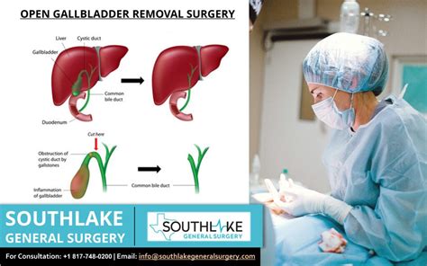 When To Remove The Gallbladder? Surgeon …