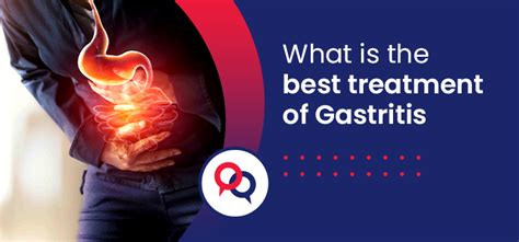 When To See A Doctor For Gastritis? - Get Second Opinion Now