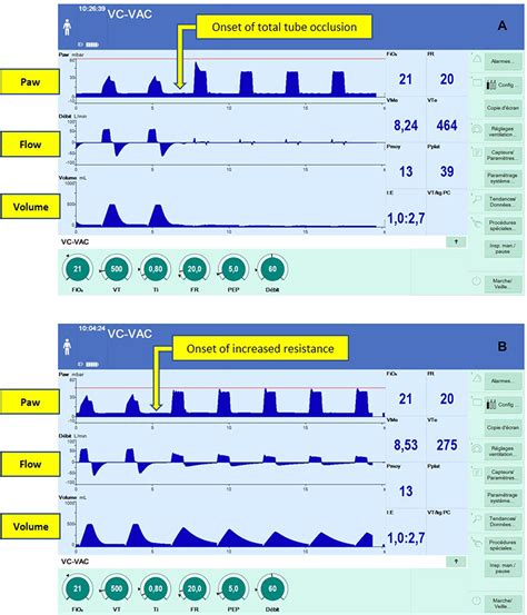 When a Ventilator Takes Autonomous Decisions without Seeking ...