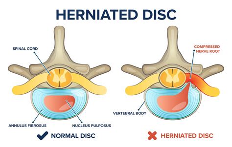 When is a herniated disc an emergency