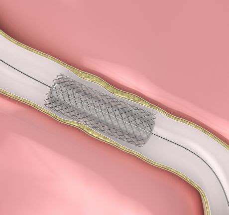 When is a stent necessary