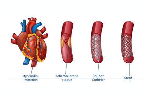 When is a stent needed