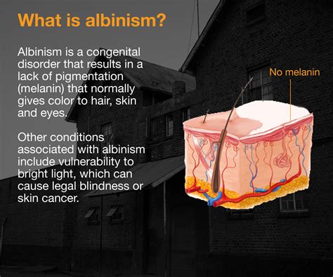 When is albinism usually detected