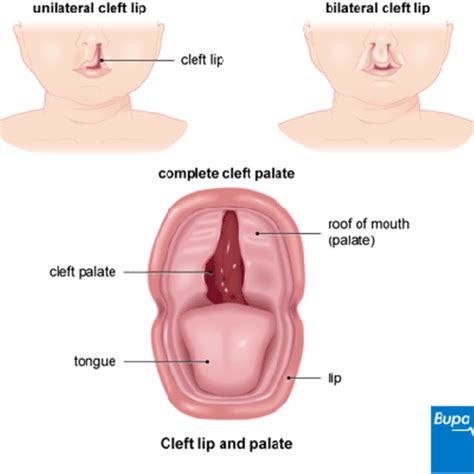 When is cleft palate formed